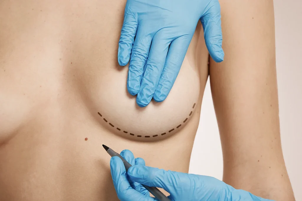 Breast Augmentation