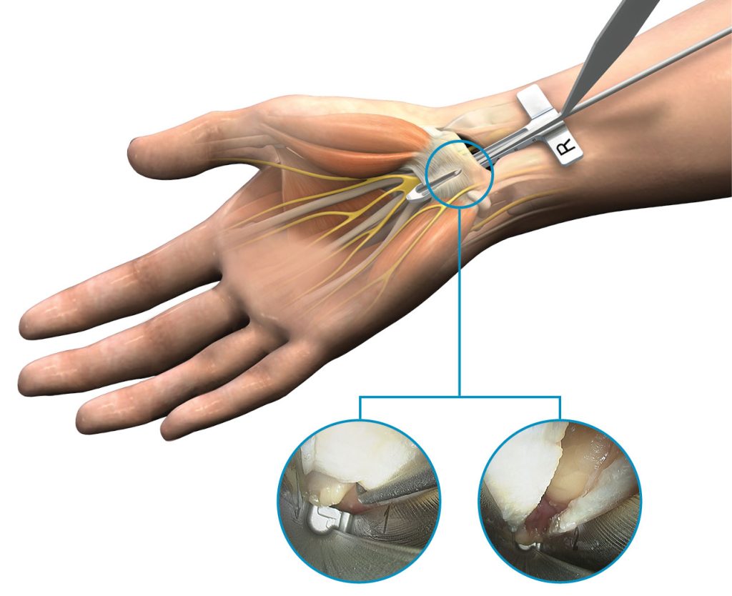 Carpal Tunnel Release
