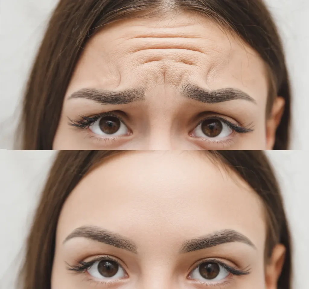 forehead lift 2