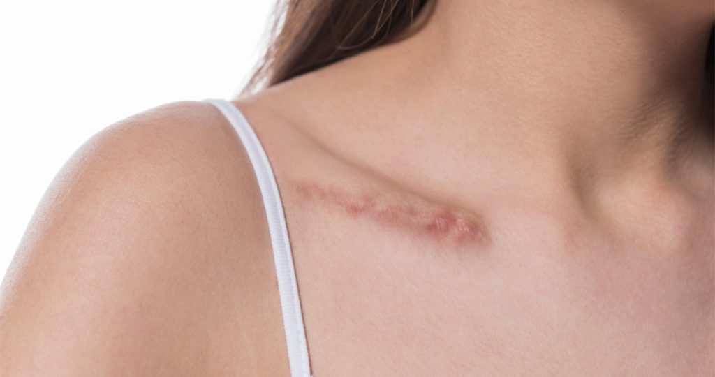 Scar Revision