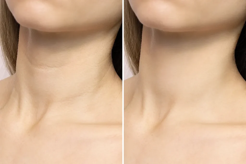 neck lift