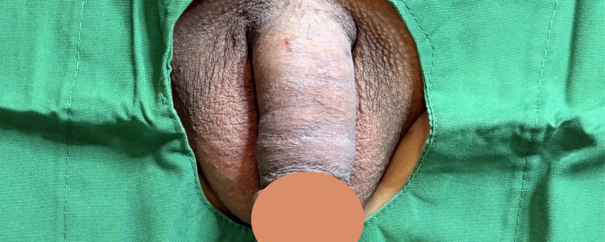 after penile enlargement