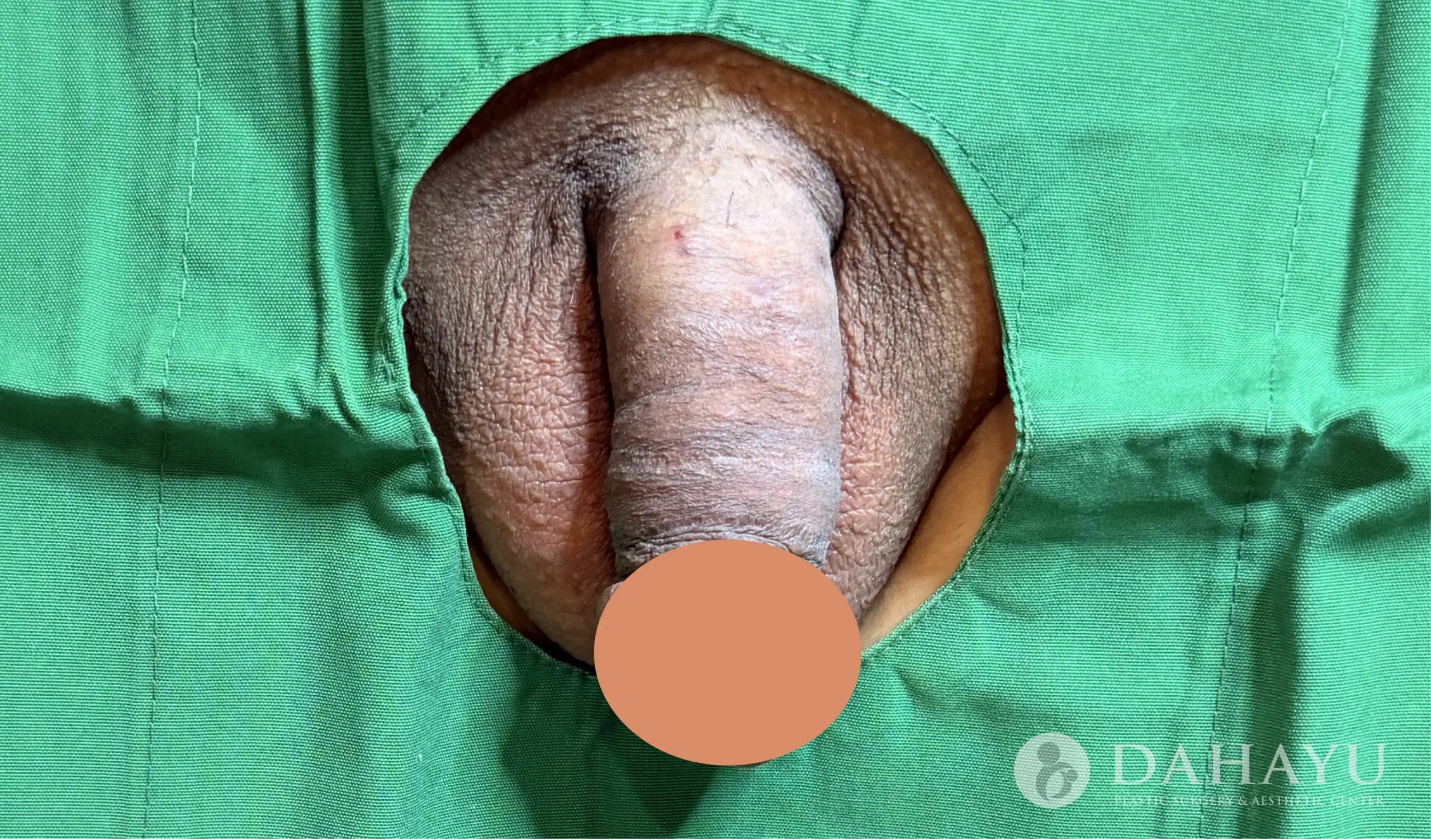 after penile enlargement